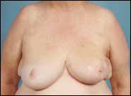 After Image: Breast Reconstruction using Breast Reduction Techniques - front