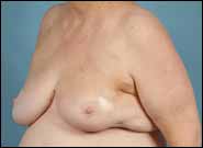 After Image: Breast Reconstruction using Breast Reduction Techniques - left-front-oblique
