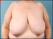 Before Image: Breast Reconstruction using Breast Reduction Techniques - front