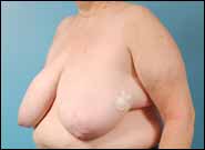 Before Image: Breast Reconstruction using Breast Reduction Techniques - left-front-oblique