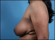 After Image: Breast Reconstruction using Breast Reduction Techniques - left-side