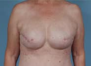After Image: Breast Reconstruction After Bilateral Nipple Sparing Mastectomies - front