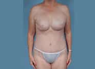 After Image: Breast Reconstruction After Bilateral Nipple Sparing Mastectomies - front