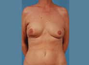 Before Image: Breast Reconstruction After Bilateral Nipple Sparing Mastectomies - front