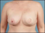 After Image: Breast Reconstruction Revision - front