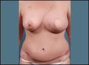 Before Image: Breast Reconstruction Revision - front