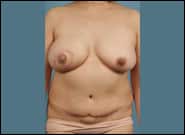 After Image: Breast Reconstruction with Diep Flap - front