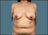 Before Image: Breast Reconstruction with Diep Flap - front