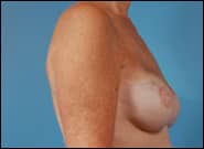 After Image: Breast Reconstruction Delayed TE with Augmentation - right-side