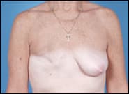 Before Image: Breast Reconstruction Delayed TE with Augmentation - front
