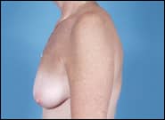 Before Image: Breast Reconstruction Delayed TE with Augmentation - left-side