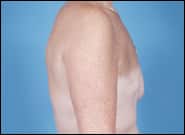 Before Image: Breast Reconstruction Delayed TE with Augmentation - right-side