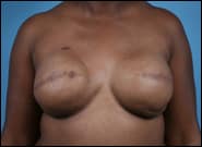 After Image: Breast Reconstruction TE Bilateral - front