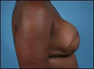 After Image: Breast Reconstruction TE Bilateral - right-side