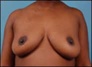 Before Image: Breast Reconstruction TE Bilateral - front