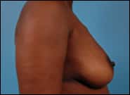 Before Image: Breast Reconstruction TE Bilateral - right-side