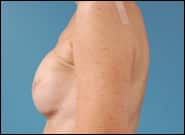 After Image: Breast Reconstruction TE Bilateral - left-side