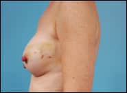 Before Image: Breast Reconstruction TE Bilateral - left-side