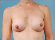 Before Image: Breast Reconstruction TE Bilateral - front
