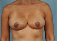 After Image: Breast Reduction - front