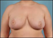 After Image: Breast Reduction - front