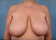 Before Image: Breast Reduction - front