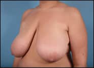 Before Image: Breast Reduction - left-front-oblique