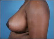 After Image: Breast Reduction - left-side