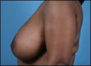 Before Image: Breast Reduction - left-side