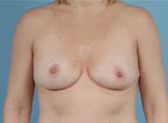 After Image: Breast Reduction - front