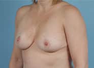 After Image: Breast Reduction - left-front-oblique
