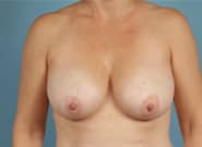 Before Image: Breast Reduction - front