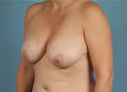 Before Image: Breast Reduction - left-front-oblique