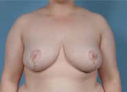 After Image: Breast Reduction - front