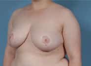 After Image: Breast Reduction - left-front-oblique