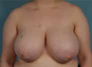 Before Image: Breast Reduction - front