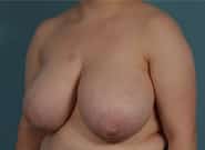 Before Image: Breast Reduction - left-front-oblique