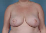 After Image: Breast Reduction - front