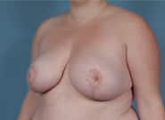 After Image: Breast Reduction - left-front-oblique