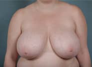 Before Image: Breast Reduction - front
