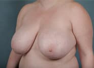 Before Image: Breast Reduction - left-front-oblique