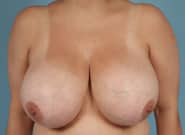 Before Image: Breast Reduction - front