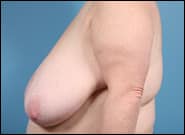 Before Image: Breast Reduction - left-side
