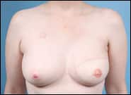 After Image: Breast reconstruction on left with DIEP flap - front