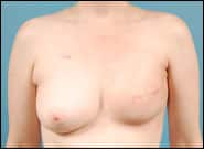 Before Image: Breast reconstruction on left with DIEP flap - front