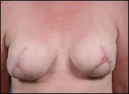 After Image: Breast Reconstruction with bilateral DIEP flap - front