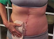 After Image: Complex Abdominal Wall Reconstruction - front