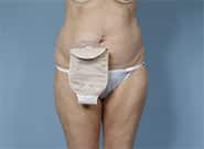 Before Image: Complex Abdominal Wall Reconstruction - front