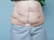 After Image: Complex Abdominal Wall Reconstruction - front
