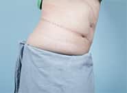 After Image: Complex Abdominal Wall Reconstruction - right-side